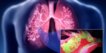 Bronsite-ne-iyi-gelir-Bronsit-icin-bitkisel-formuller