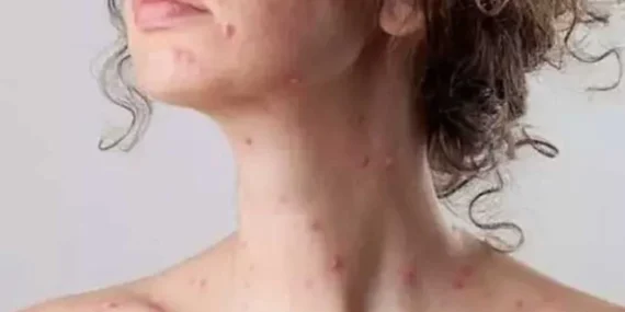 Çiçek Hastalığı Tedavisi Hakkında