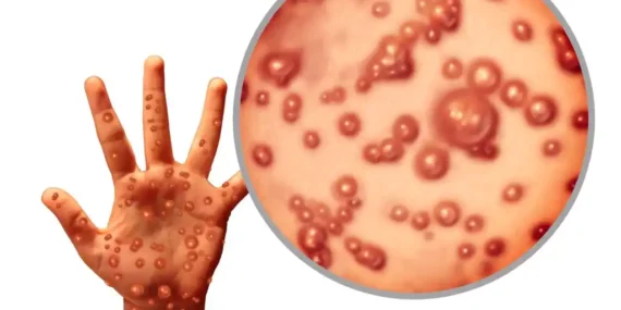 Çicek Hastalığı nedir?