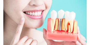 dis-implantlari-hakkinda-bilmeniz-gereken-9-bilgi